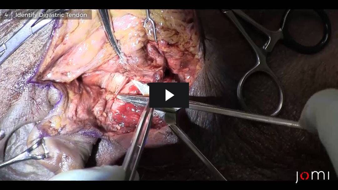 Video preload image for Parotid Dissection (Cadaver)