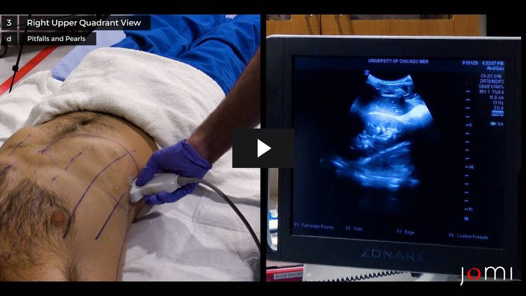 Video preload image for Extended Focused Assessment with Sonography for Trauma (EFAST) Exam