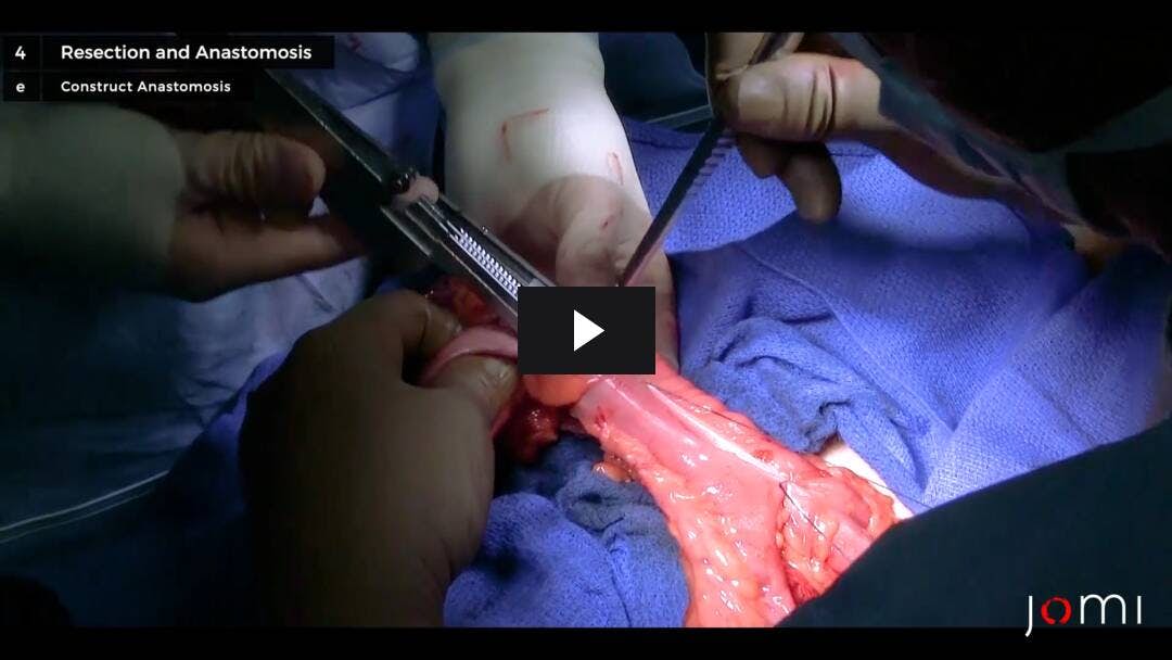 Video preload image for Laparoskopische Rechtskolektomie mit ileokoler Anastomose