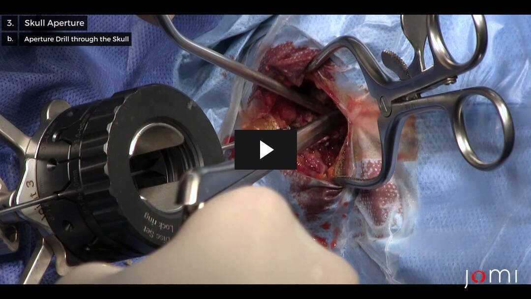 Video preload image for Hirnbiopsie eines vermuteten Kleinhirnlymphoms
