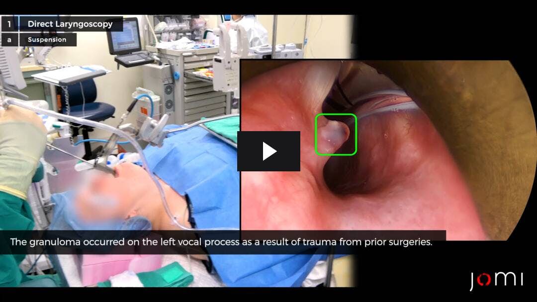 Video preload image for Microlaringoscopia directa y escisión de la lesión de las cuerdas vocales
