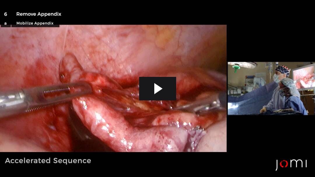 Video preload image for Apendicectomía laparoscópica a intervalos y reparación abierta de hernia umbilical