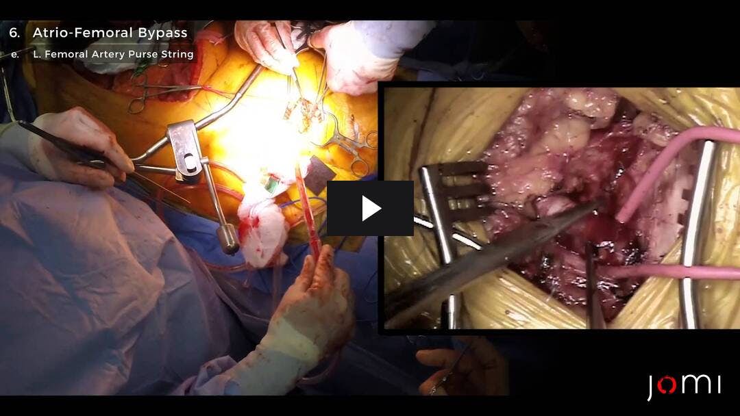 Video preload image for Reparación del aneurisma aórtico toracoabdominal - Parte 1