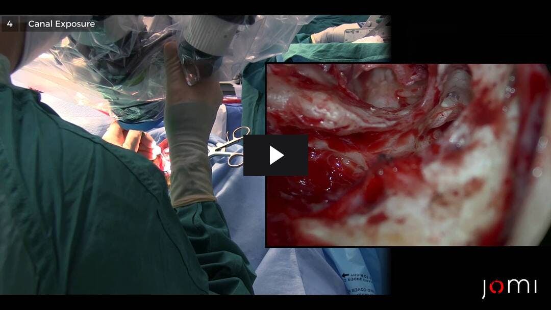 Video preload image for Tympanoplasty (Revision)