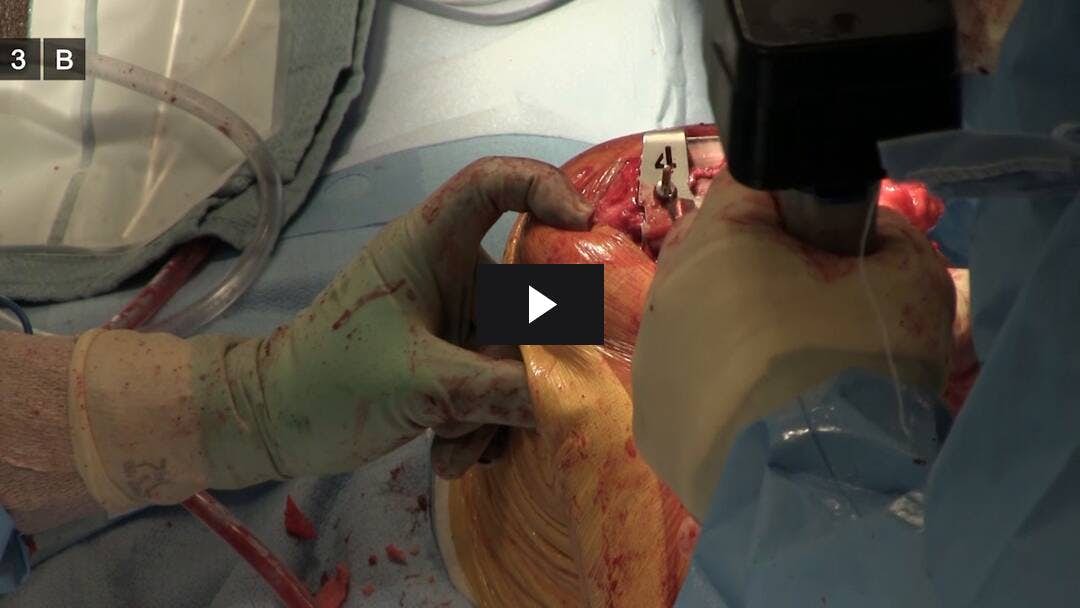 Video preload image for Total Knee Arthroplasty