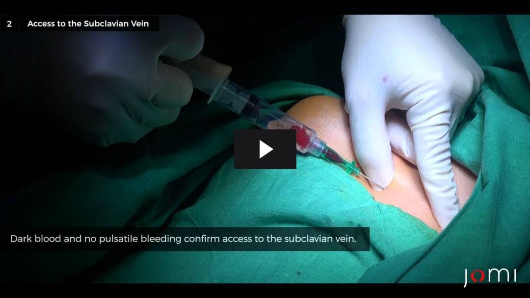 Video preload image for Canulación de la vena subclavia infraclavicular en un paciente pediátrico sin guía ultrasonográfica previa a una interposición de colon en Honduras durante una misión quirúrgica