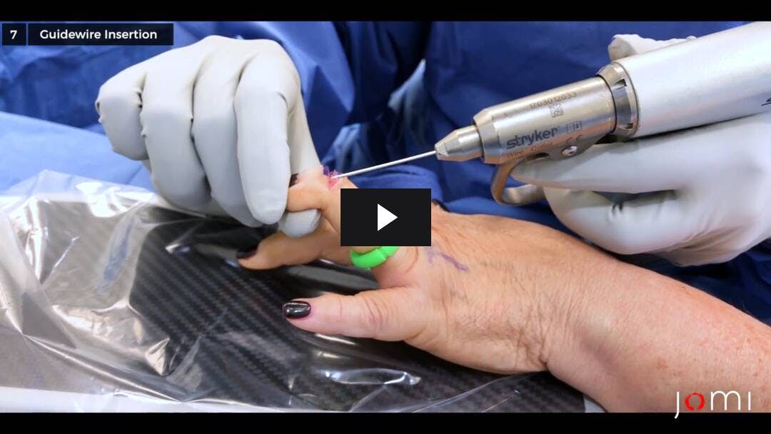 Video preload image for Arthrodese des distalen Interphalangealgelenks (DIP) des rechten Ringfingers bei Arthritis