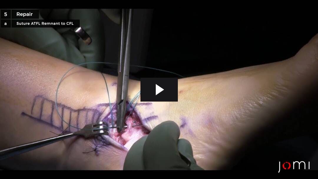 Video preload image for Brostrom-Gould Procedure for Lateral Ankle Instability