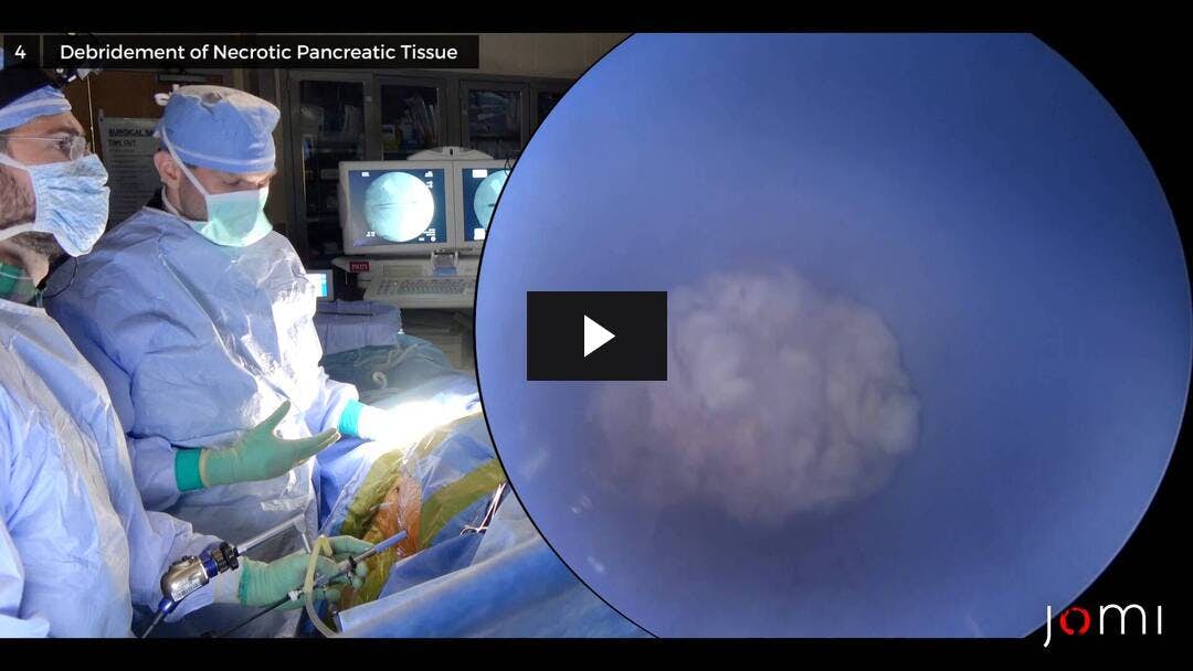 Video preload image for Pancreatic Debridement via Sinus Tract Endoscopy