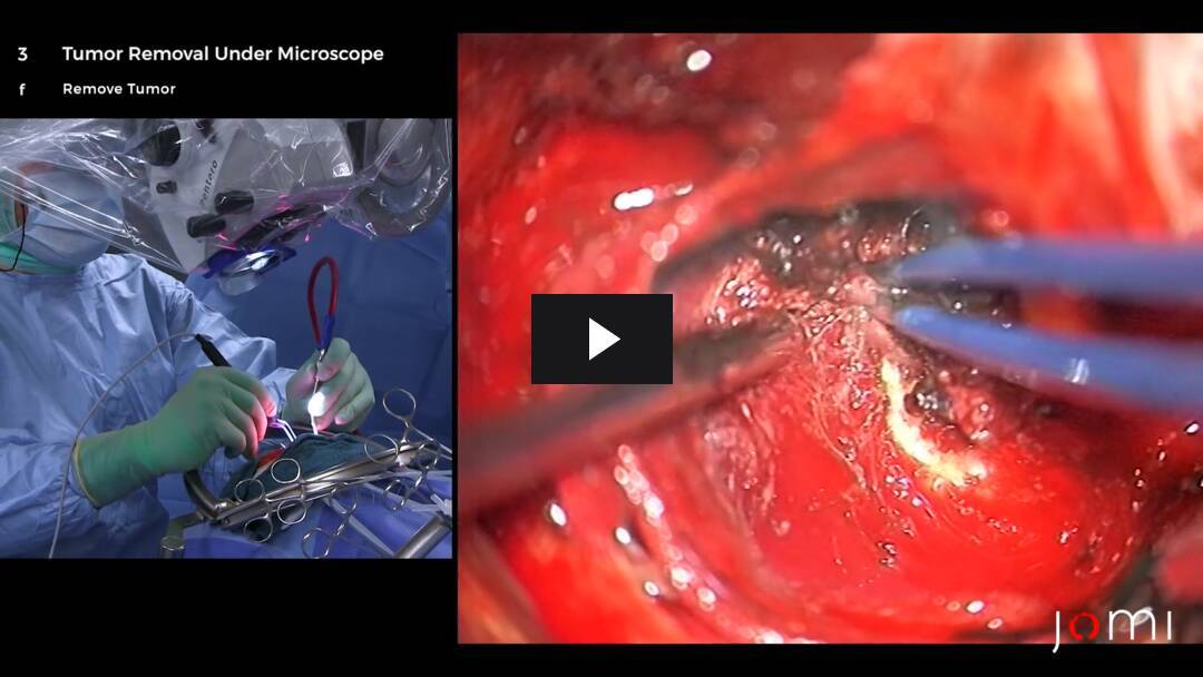 Video preload image for Resection of a Sphenoid Wing Meningioma