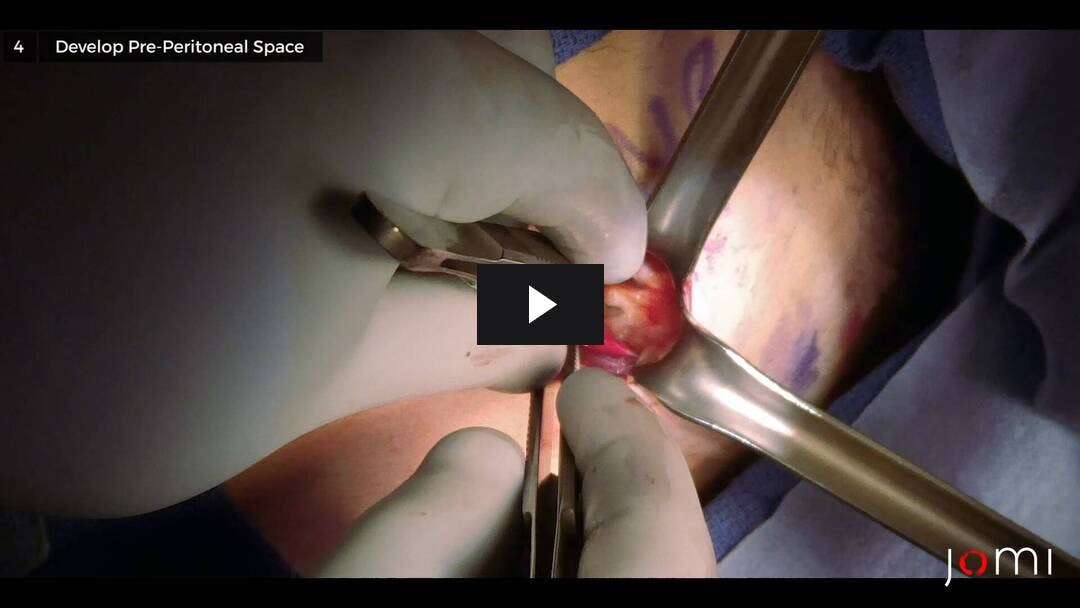 Video preload image for Reparación mínimamente invasiva de hernia inguinal preperitoneal abierta