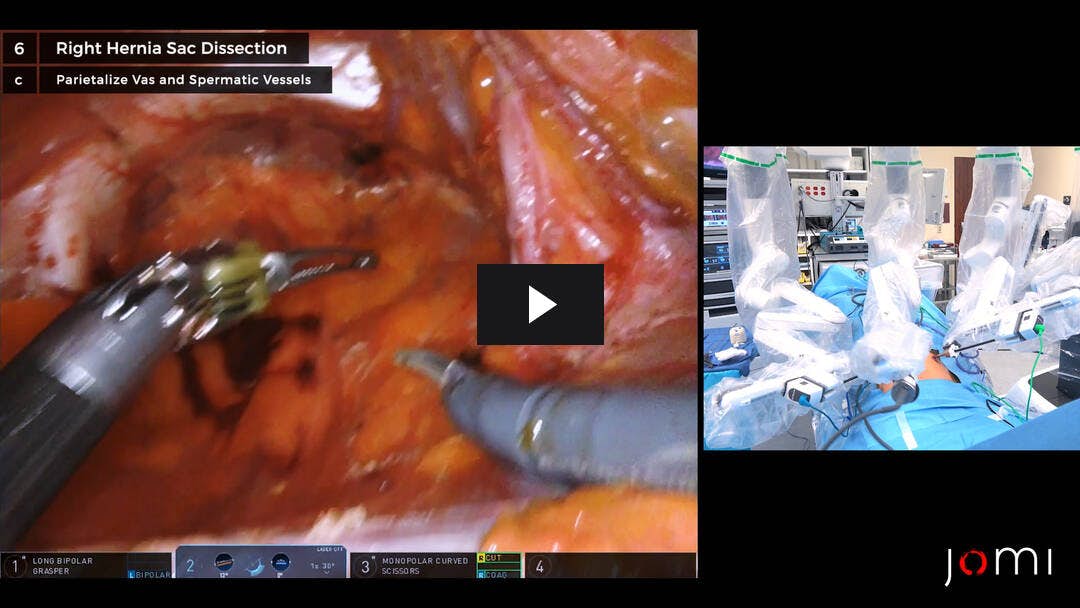 Video preload image for Reparación de hernia inguinal bilateral asistida por robot (rTAPP)