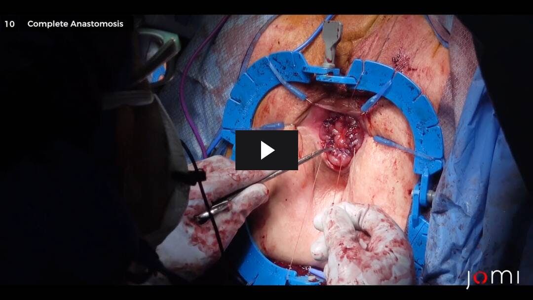 Video preload image for Altemeier Perineale Proktosigmoidektomie bei Rektumprolaps