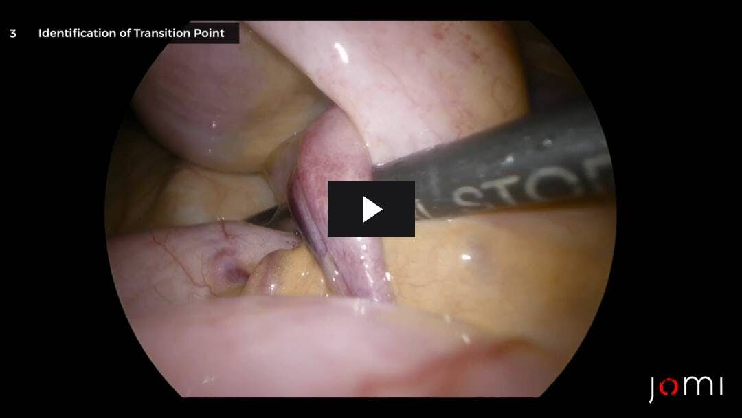 Video preload image for Laparoscopic Lysis of Adhesions for Closed Loop Small Bowel Obstruction