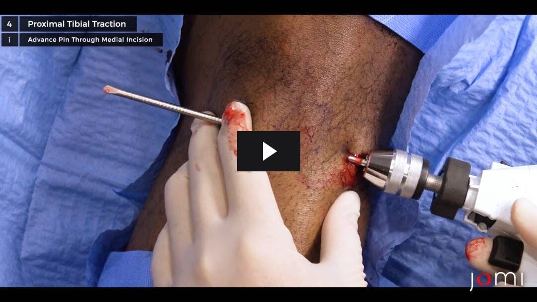 Video preload image for 발목-상완 지수, CT 혈관 조영술 및 총상 대퇴 골절에 대한 근위 경골 견인