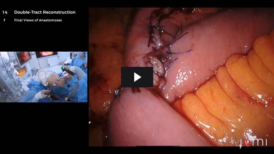 Video preload image for Robotic-Assisted Proximal Gastrectomy with a Laparoscopic-Assisted Double-Tract Reconstruction for Proximal Early Gastric Cancer