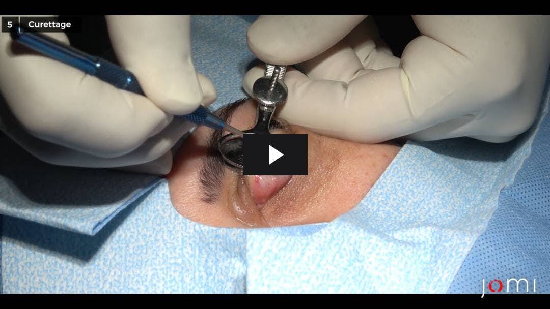 Video preload image for 왼쪽 위 눈꺼풀 Chalazion의 절개 및 소파술