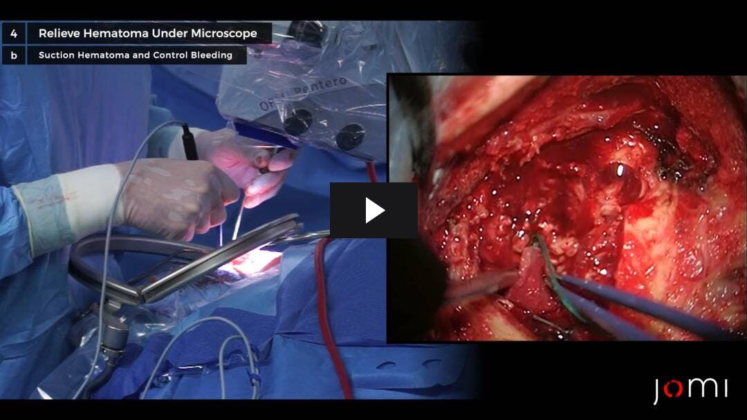 Video preload image for Extraventricular Drainage and Hematoma Evacuation to Treat Hydrocephalus Following Lysis of MCA Embolism