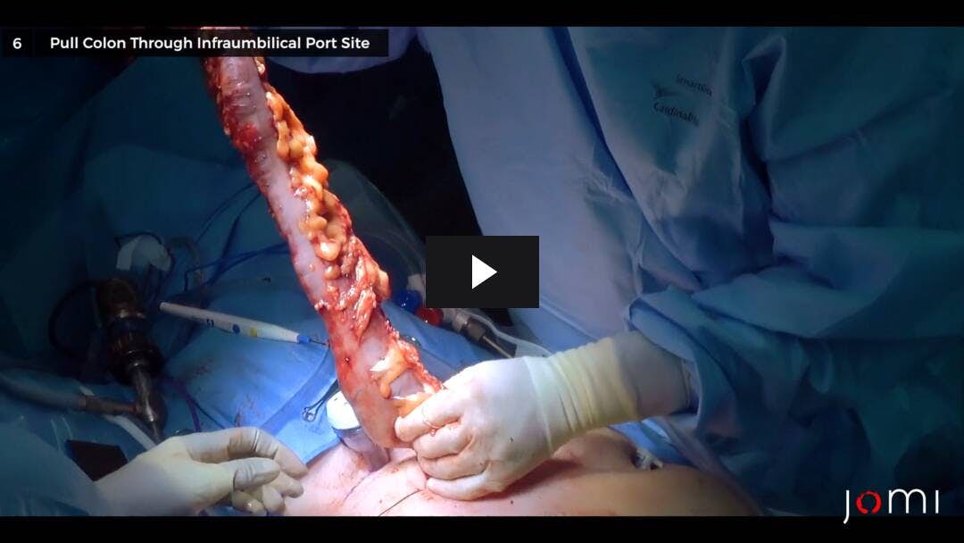 Video preload image for Colectomía abdominal total laparoscópica con anastomosis ileorrectal para la colitis de Crohn y la displasia multifocal