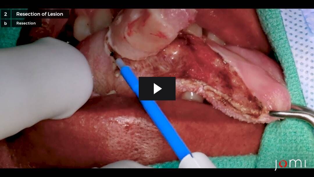 Video preload image for Partial Glossectomy