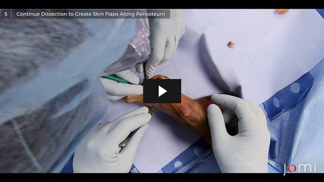 Video preload image for Amputación del primer dedo del pie izquierdo (rayo, cadáver)
