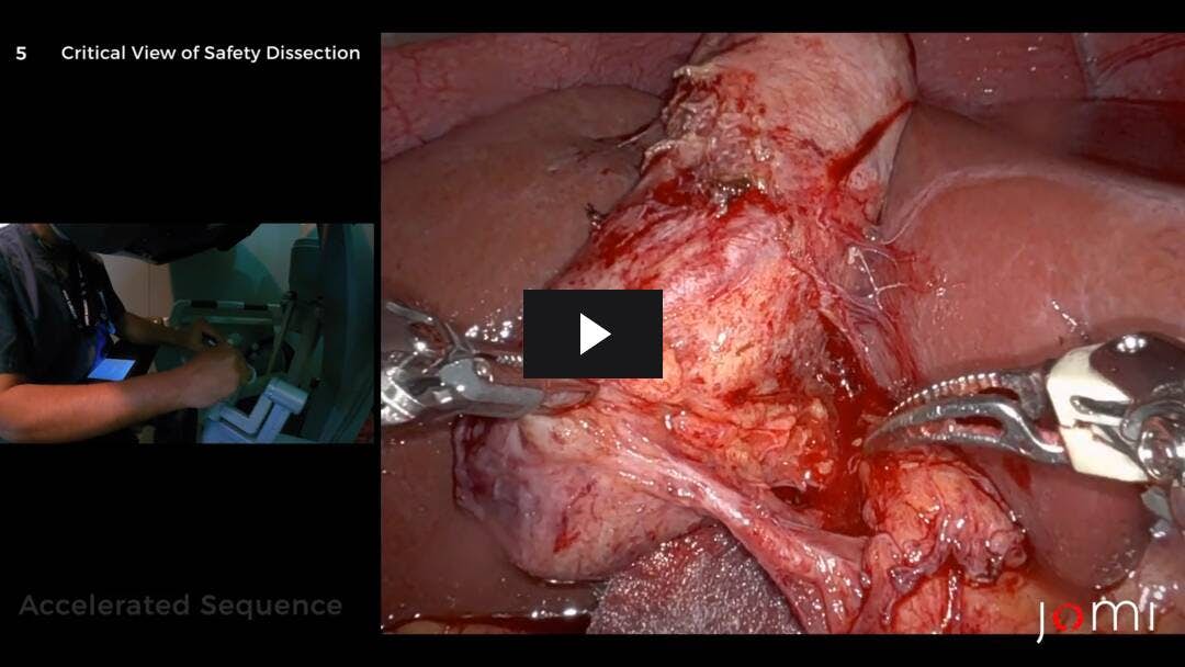 Video preload image for Robotic-Assisted Laparoscopic Interval Cholecystectomy
