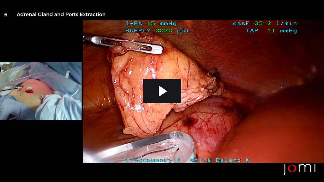 Video preload image for Surrénalectomie droite laparoscopique transpéritonéale pour adénome cortical