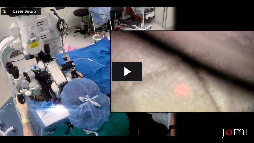Video preload image for Myringoplasty and Tympanostomy Tube Placement