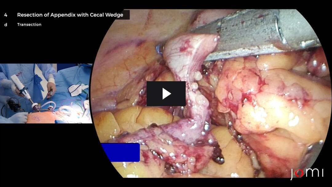 Video preload image for Apendicectomía laparoscópica de resección en cuña cecal