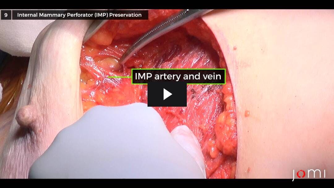Video preload image for Internal Mammary Perforator Preserving Nipple-Sparing Mastectomy (IMP-NSM) to Reduce Ischemic Complications