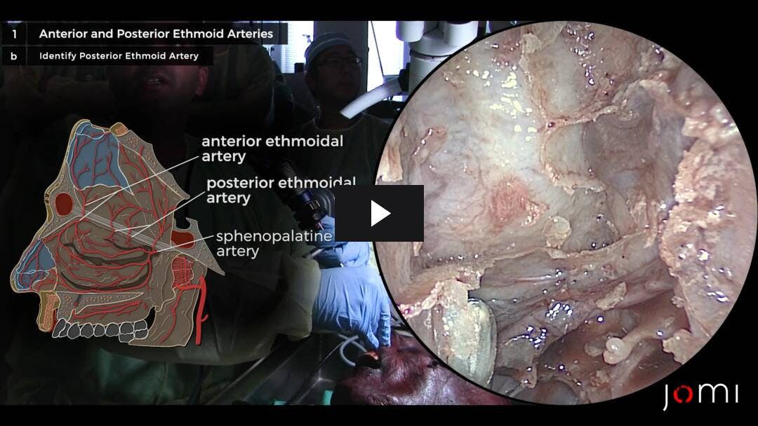 Video preload image for Ethmoid Artery Anatomy (Cadaver)