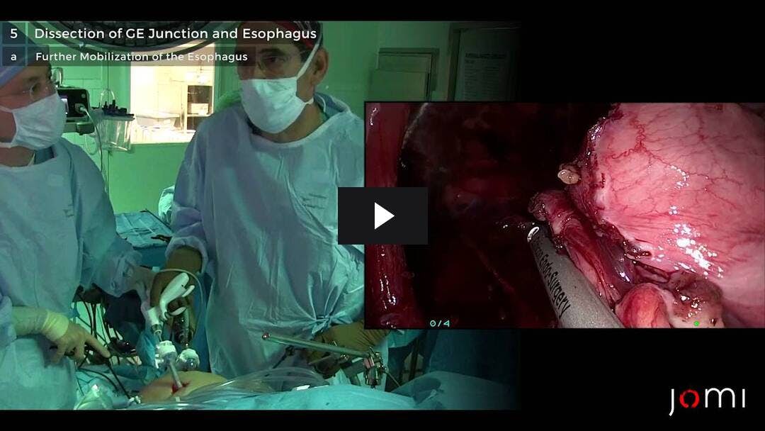 Video preload image for Reparación laparoscópica de hernia paraesofágica