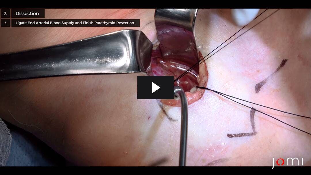 Video preload image for Minimalinvasive Parathyreoidektomie unter örtlicher zervikaler Blockanästhesie bei primärem Hyperparathyreoidismus und Parathormonadenom
