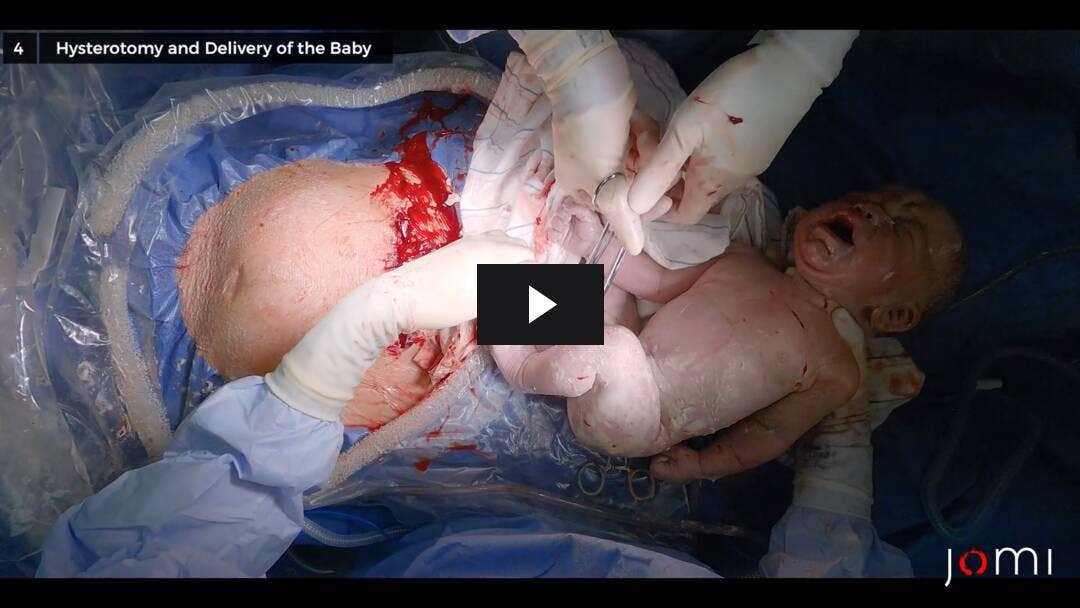 Video preload image for Primary Low Transverse C-Section