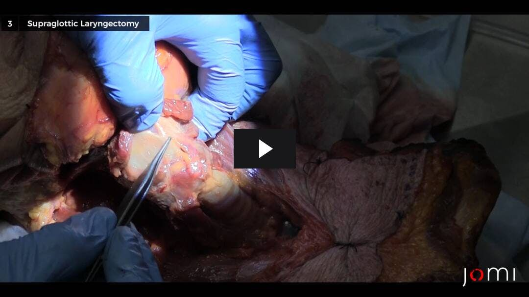 Video preload image for आंशिक Laryngectomy तकनीक की समीक्षा और Cricohyodoepiglottopexy के साथ Supracricoid Laryngectomy के प्रदर्शन (Cadaver)