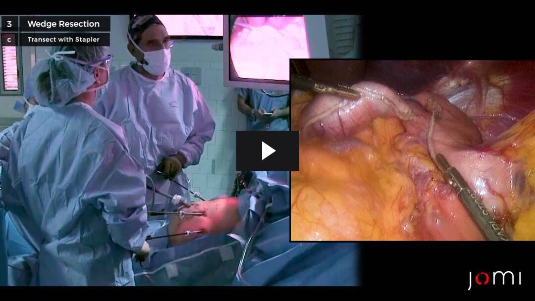 Video preload image for Resección laparoscópica del tumor GIST gástrico