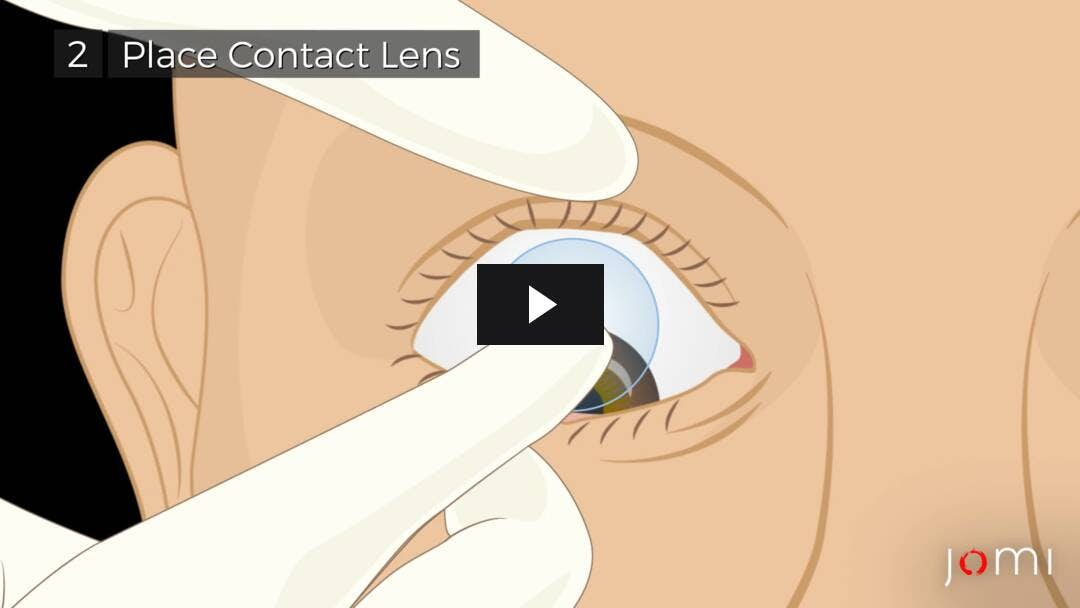 Video preload image for Placement and Removal of Bandage Contact Lens