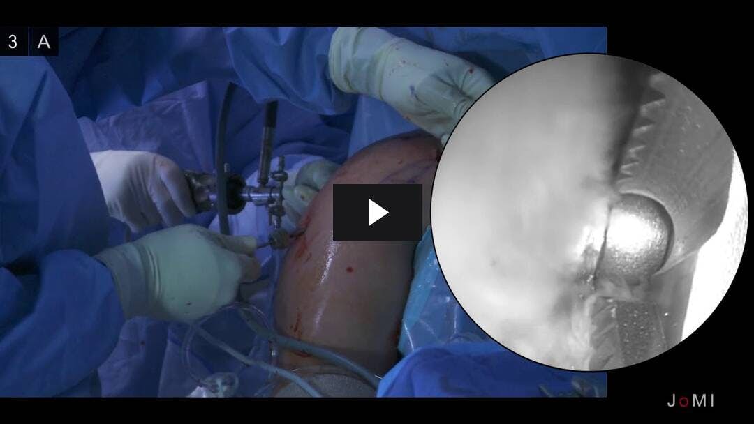 Video preload image for Arthroskopisches Total Shoulder Resurfacing mit osteochondralem Allotransplantat