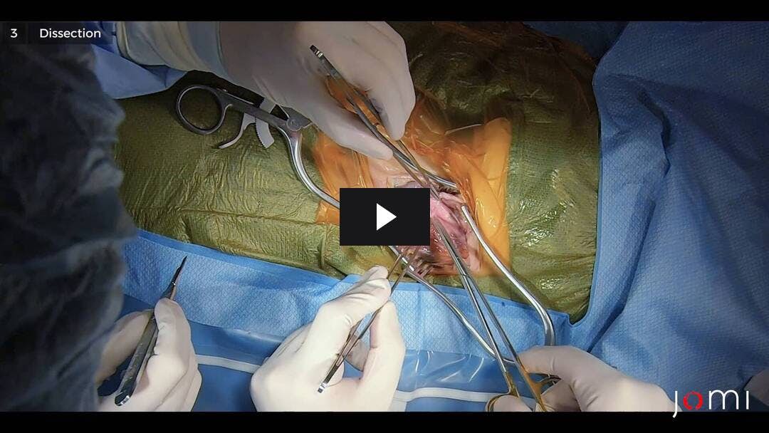 Video preload image for Carotid Endarterectomy (Cadaver)