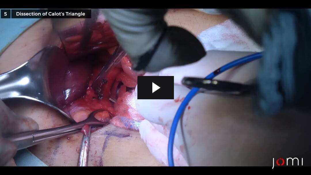 Video preload image for 담낭 질환에 대한 개방 담낭 절제술