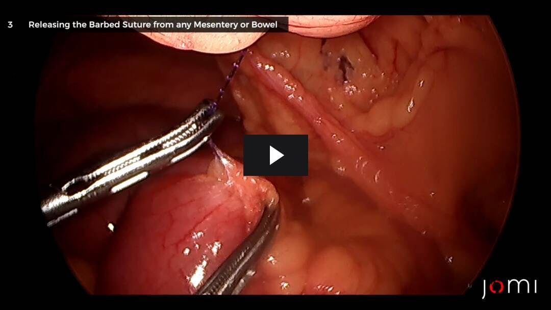 Video preload image for Small Bowel Obstruction Following Robotic Transabdominal Preperitoneal Ventral Hernia Repair (rTAPP) Due to Barbed Suture