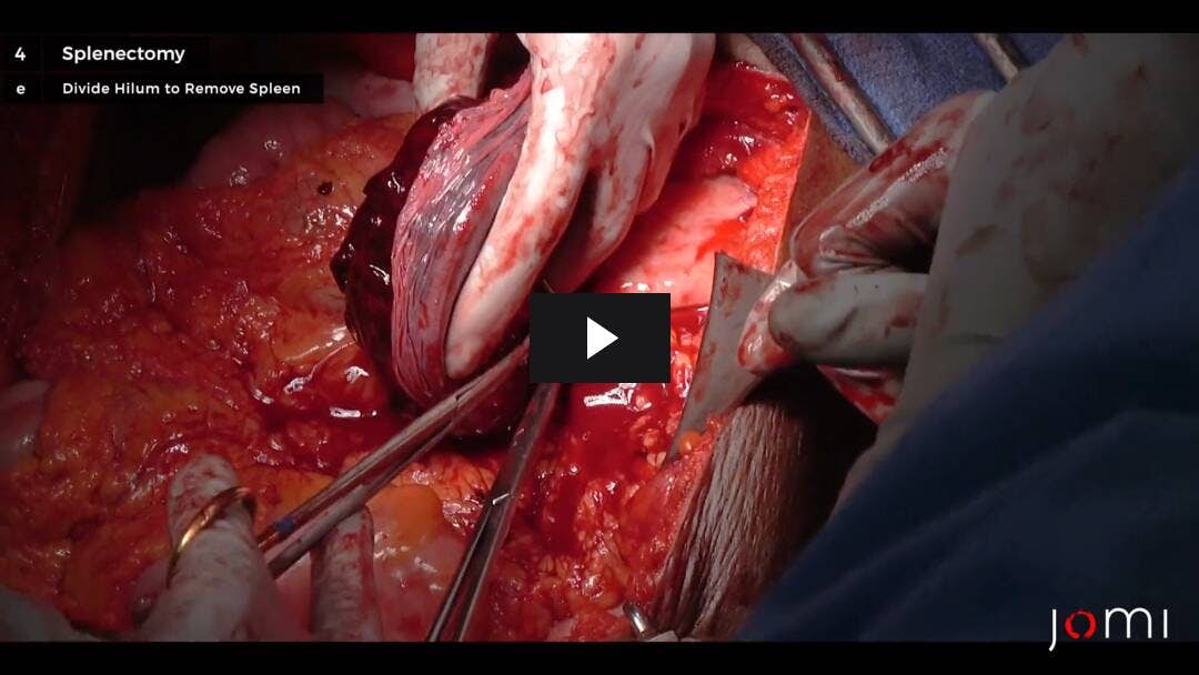 Video preload image for Laparotomía exploratoria y esplenectomía para la ruptura del bazo después de un traumatismo por fuerza contundente