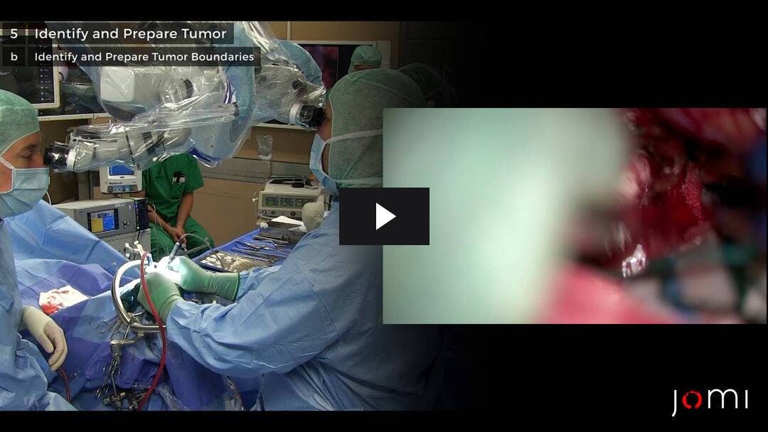 Video preload image for Resección del tumor intraventricular