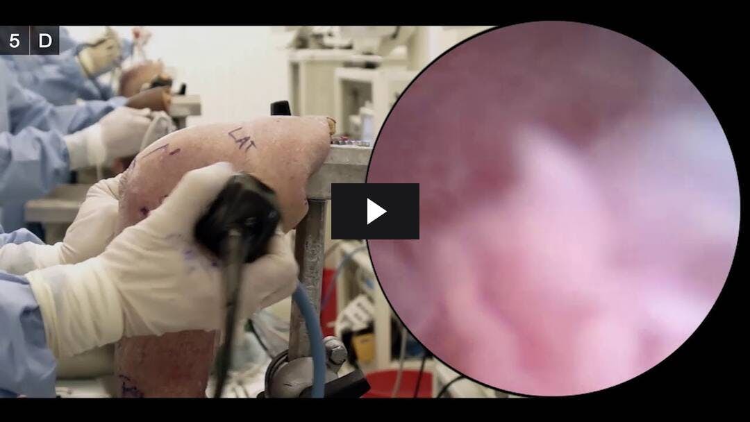Video preload image for Elbow Arthroscopy