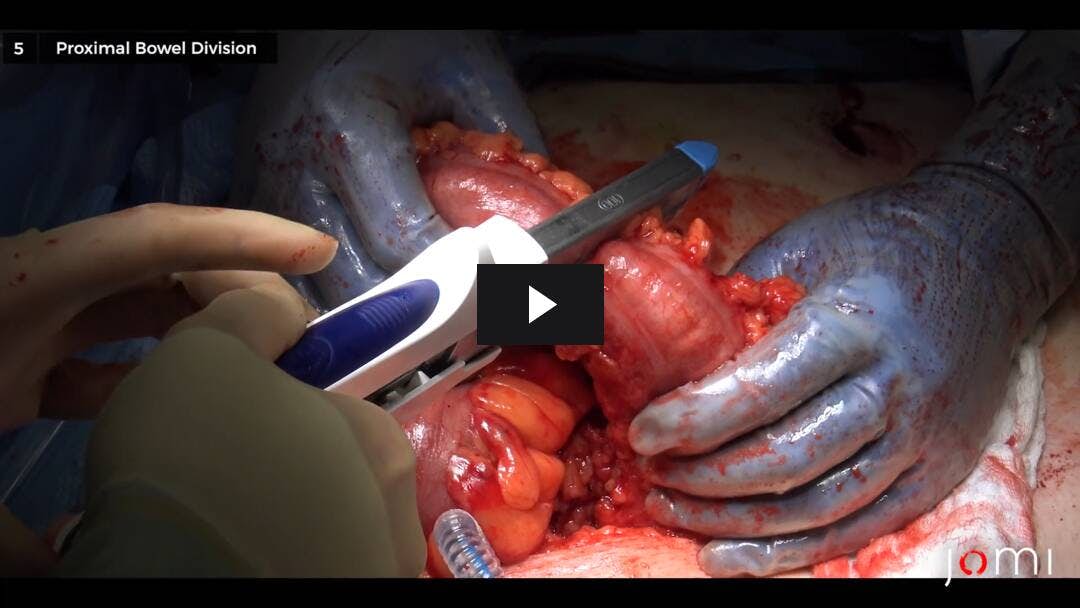 Video preload image for Resección laparoscópica anterior baja con ileostomía de asa de desvío para cáncer de recto con conversión a abordaje abierto