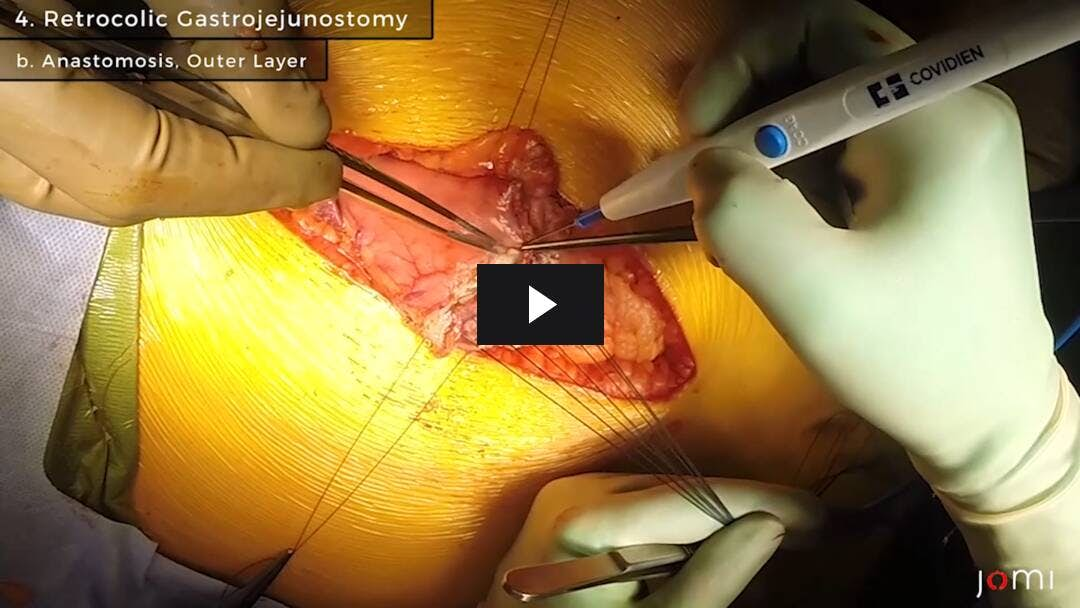 Video preload image for Open Antrectomy and Duodenal Resection for Neuroendocrine Tumor