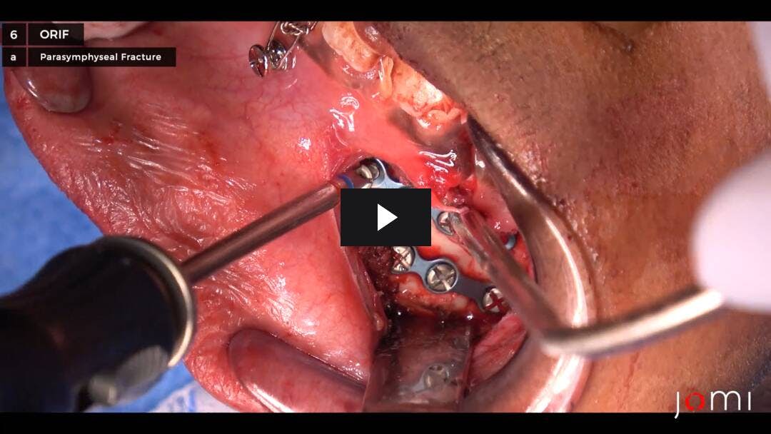 Video preload image for Open Reduction and Internal Fixation of Mandibular Body and Parasymphyseal Fractures with Maxillomandibular Fixation and Broken Tooth Extraction