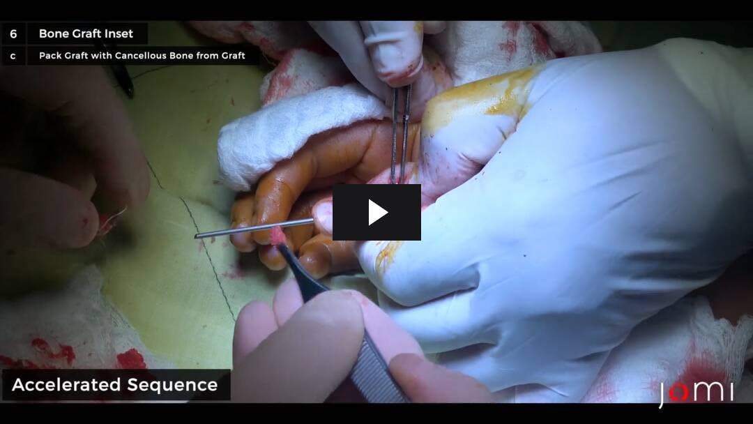 Video preload image for Bone Graft for Nonunion of Right Thumb Proximal Phalanx Fracture
