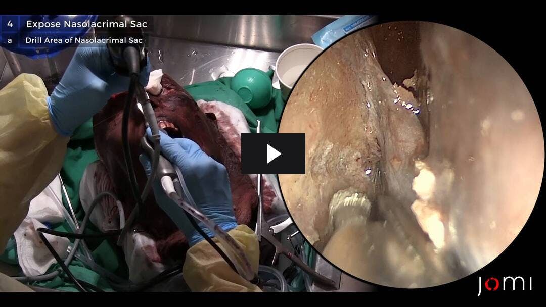 Video preload image for DCR and Nasolacrimal System (Cadaver)