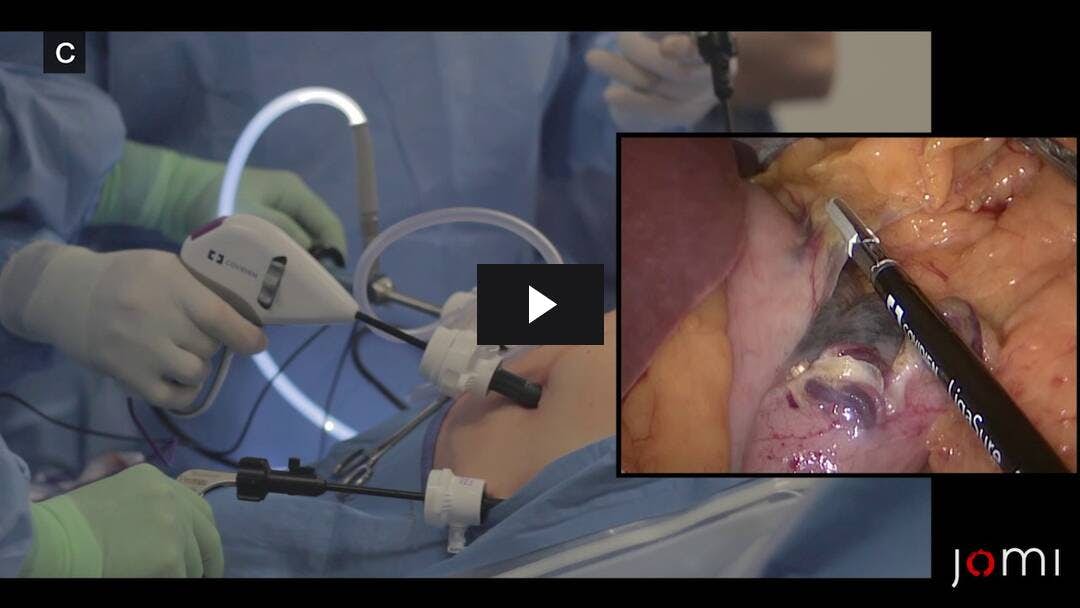 Video preload image for Resección laparoscópica en cuña gástrica